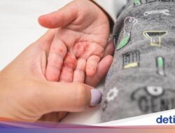 Heboh Imbauan Flu Singapura Di Sekolah-sekolah, Dinkes DKI Beberkan Gejalanya