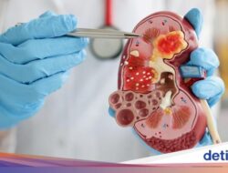 10 Tanda yang Muncul Pada Ginjal Bermasalah, Bengkak-Rasa Gatal Hingga Kulit