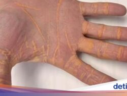 Kacau! 5 Orang Ini Alami Efek Samping Ekstrem Usai Terlalu Banyak Makan
