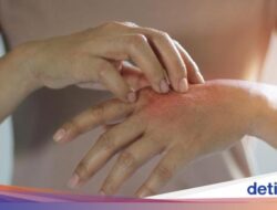 6 Minuman Herbal Sebagai Mengobati Kulit Gatal, Ada Jahe-Teh Hijau